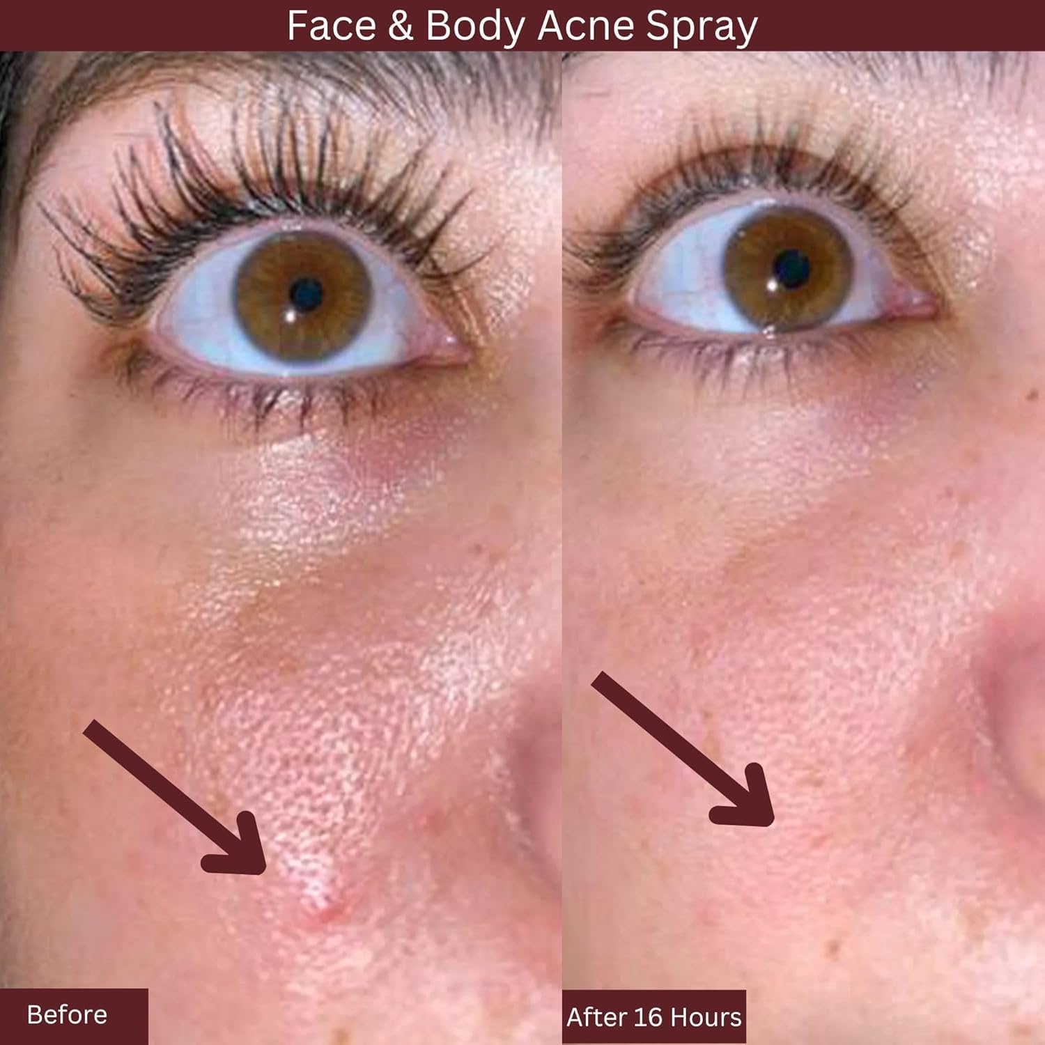 ITK Skincare Spray formulation naturelle, 2% acide salicylique et actifs apaisants