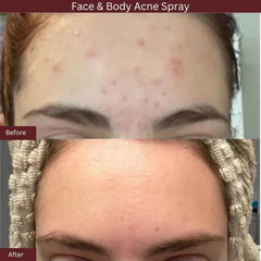 ITK Skincare Spray visage-bacne-points-noirs, aide à réduire les imperfections visibles