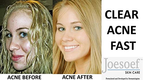 JOESOEF SKIN CARE Pores obstrués, respiration cutanée facilitée