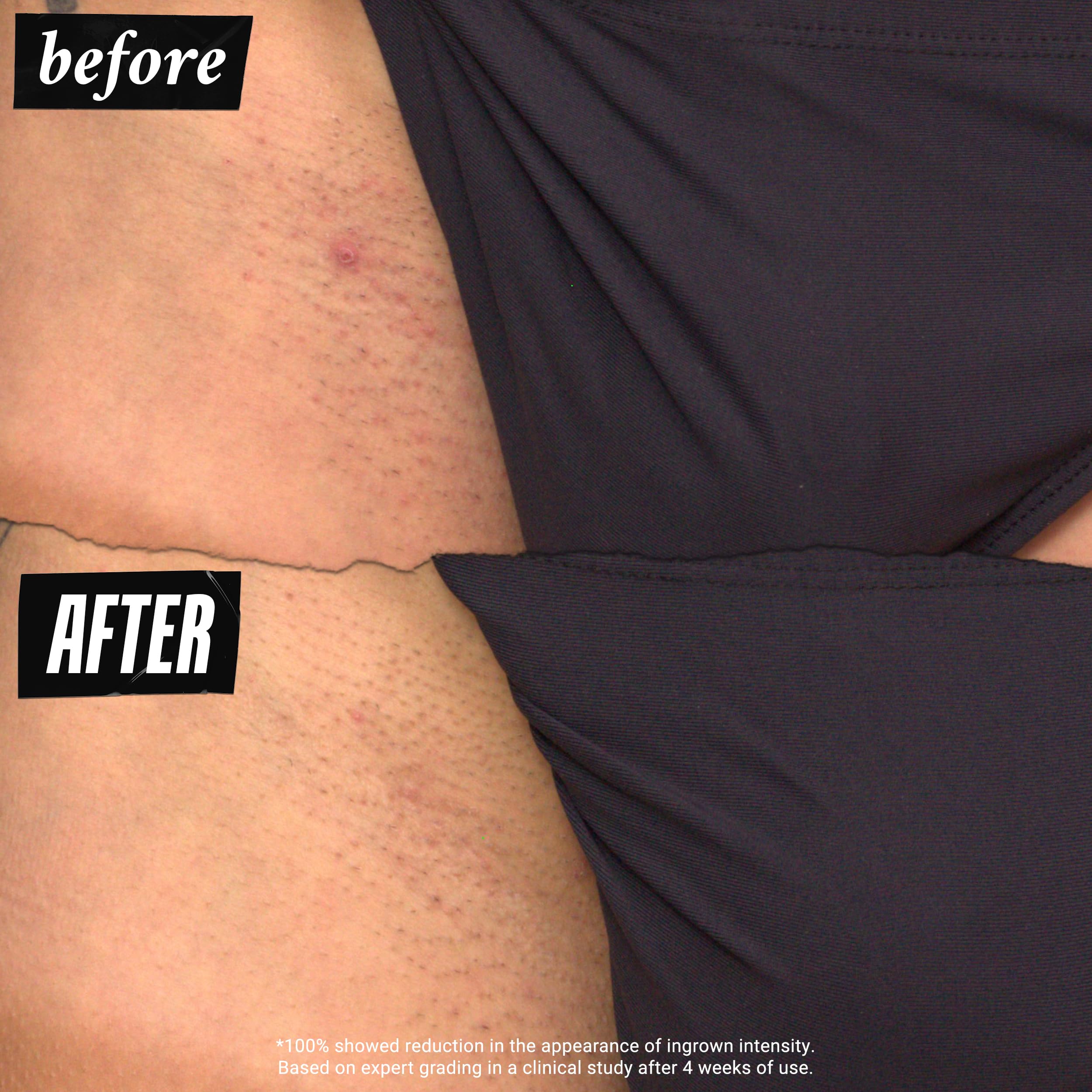 Kiehl's Ingrown Hair Drops – usage pré et post épilation recommandé.