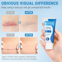 Kunyle Gel Silicone : application en massage circulaire, utilisation quotidienne possible.