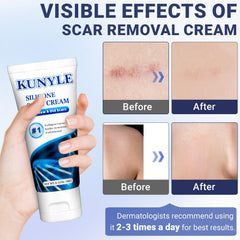 Kunyle Gel silicone cicatrices, application massage pour atténuer les cicatrices.