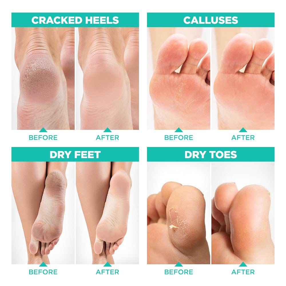 Lavinso Mélange botanique Exfoliant Pieds – solution naturelle pour rugosités.