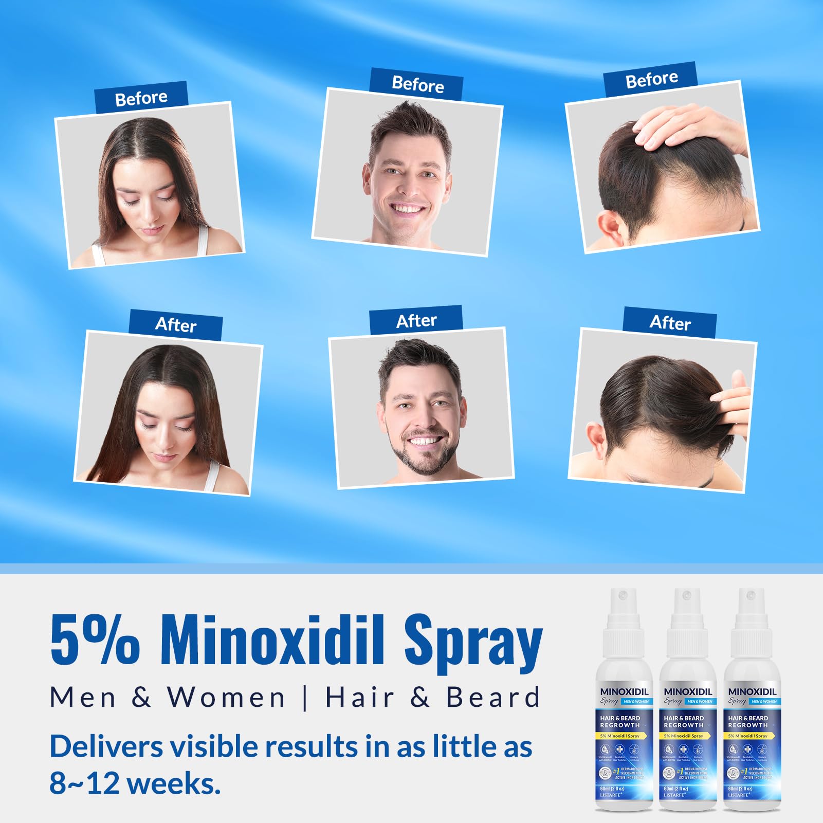 Listarfe pulvérisateur Minoxidil 3 pièces, flacon en main pour densité visuelle des cheveux.