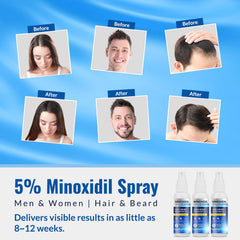 Listarfe pulvérisateur Minoxidil 3 pièces, flacon en main pour densité visuelle des cheveux.