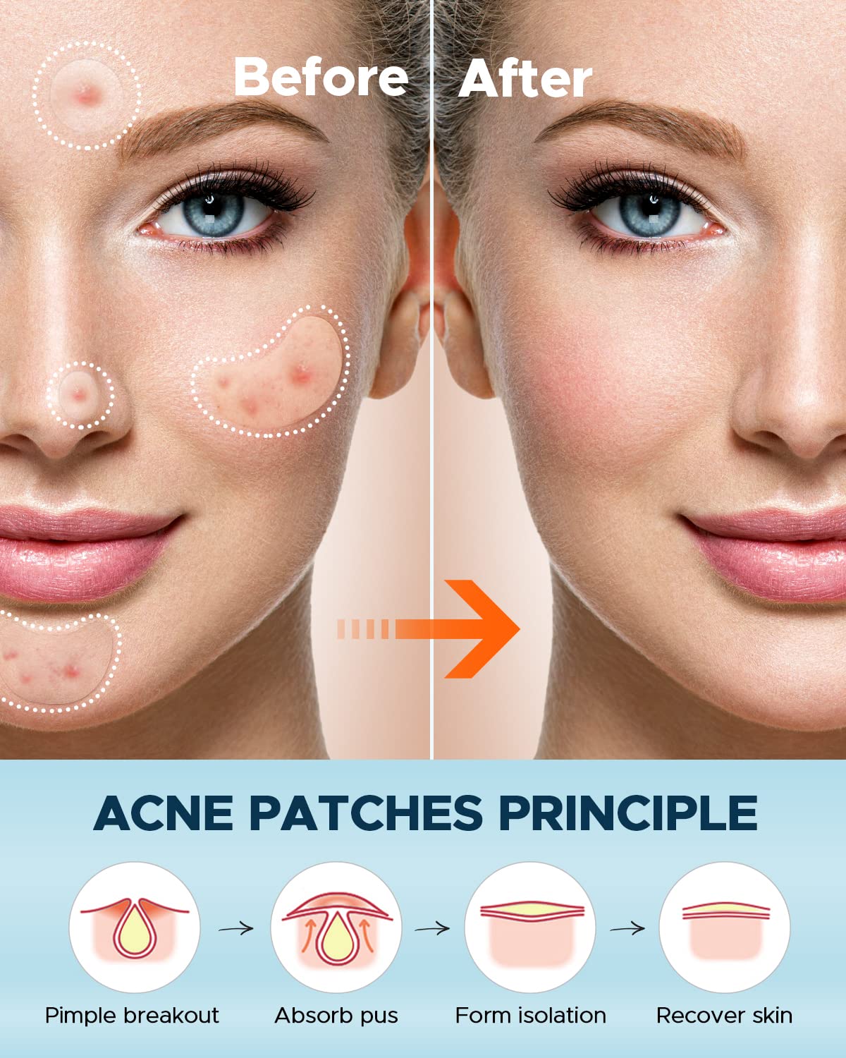 LitBear coffret patch acne, coffret pratique et prêt à l'emploi.