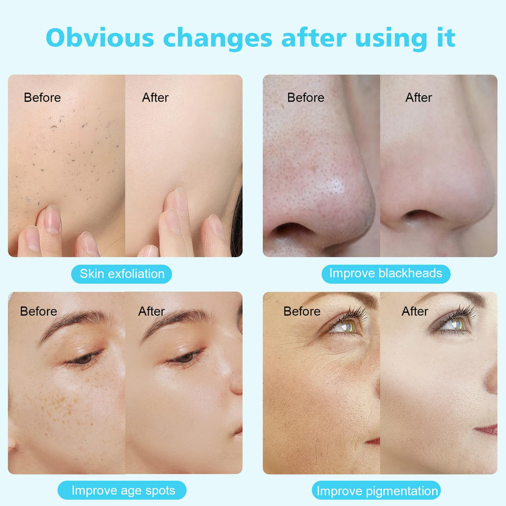 Ensemble accessoires dermabrasion MCWDOIT pour routine complète.