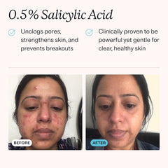 MDacne extrait de réglisse et vitamine C pour teint uniforme.
