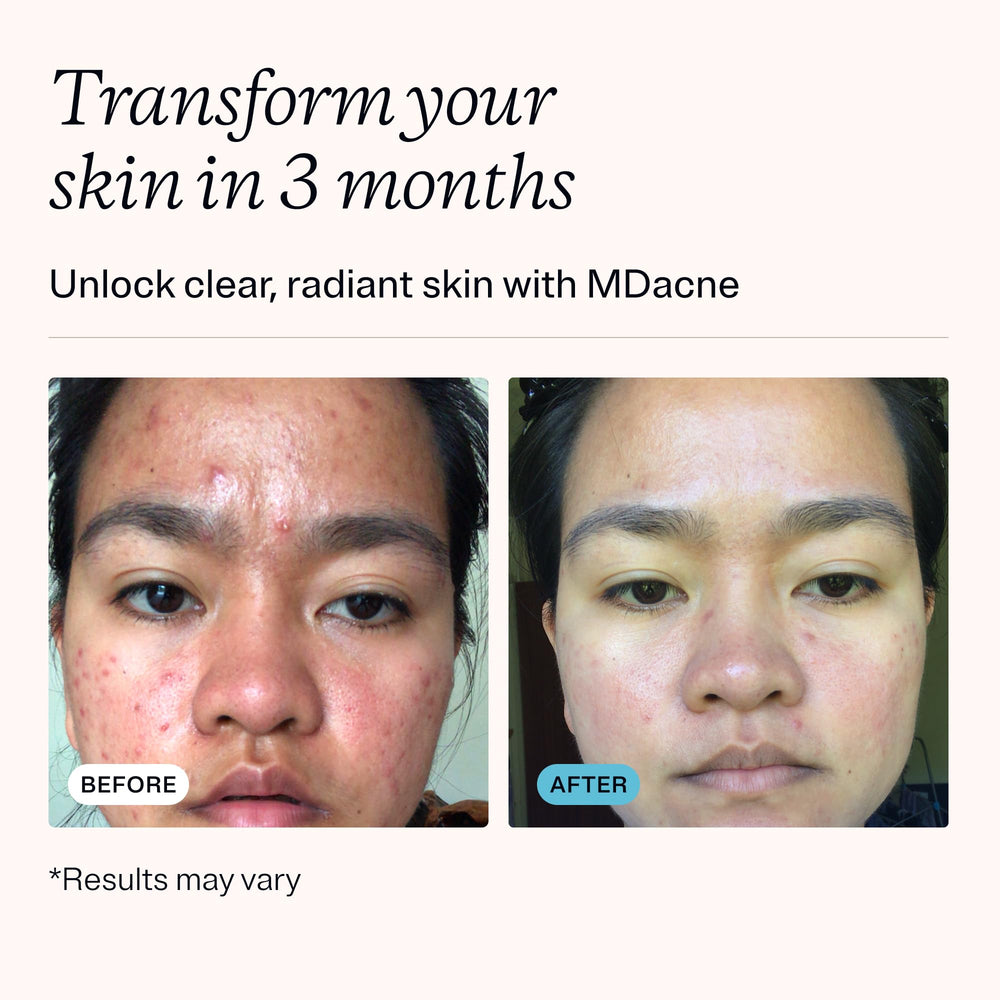 MDacne nettoyant acide salicylique 0,5% pour pores propres