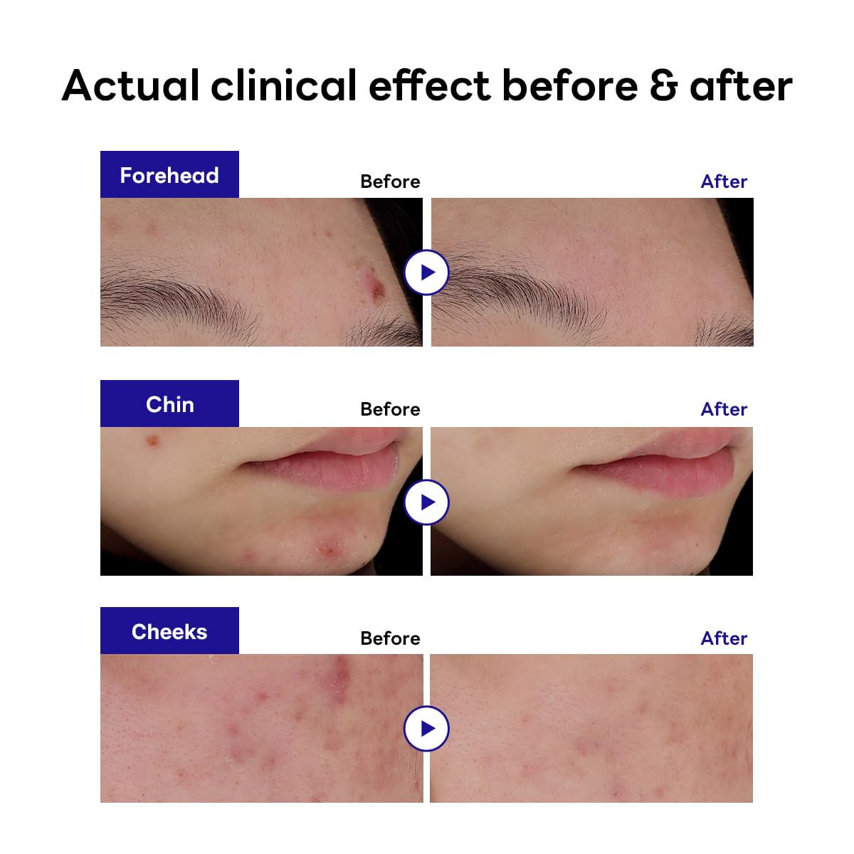 Barrière protectrice Mediheal Derma Clear sur peau irritée.