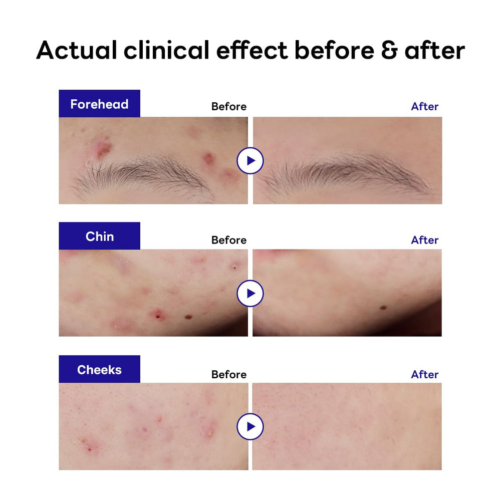 Mediheal Derma Clear pansement matte et transparent couvre rougeurs sans trace.