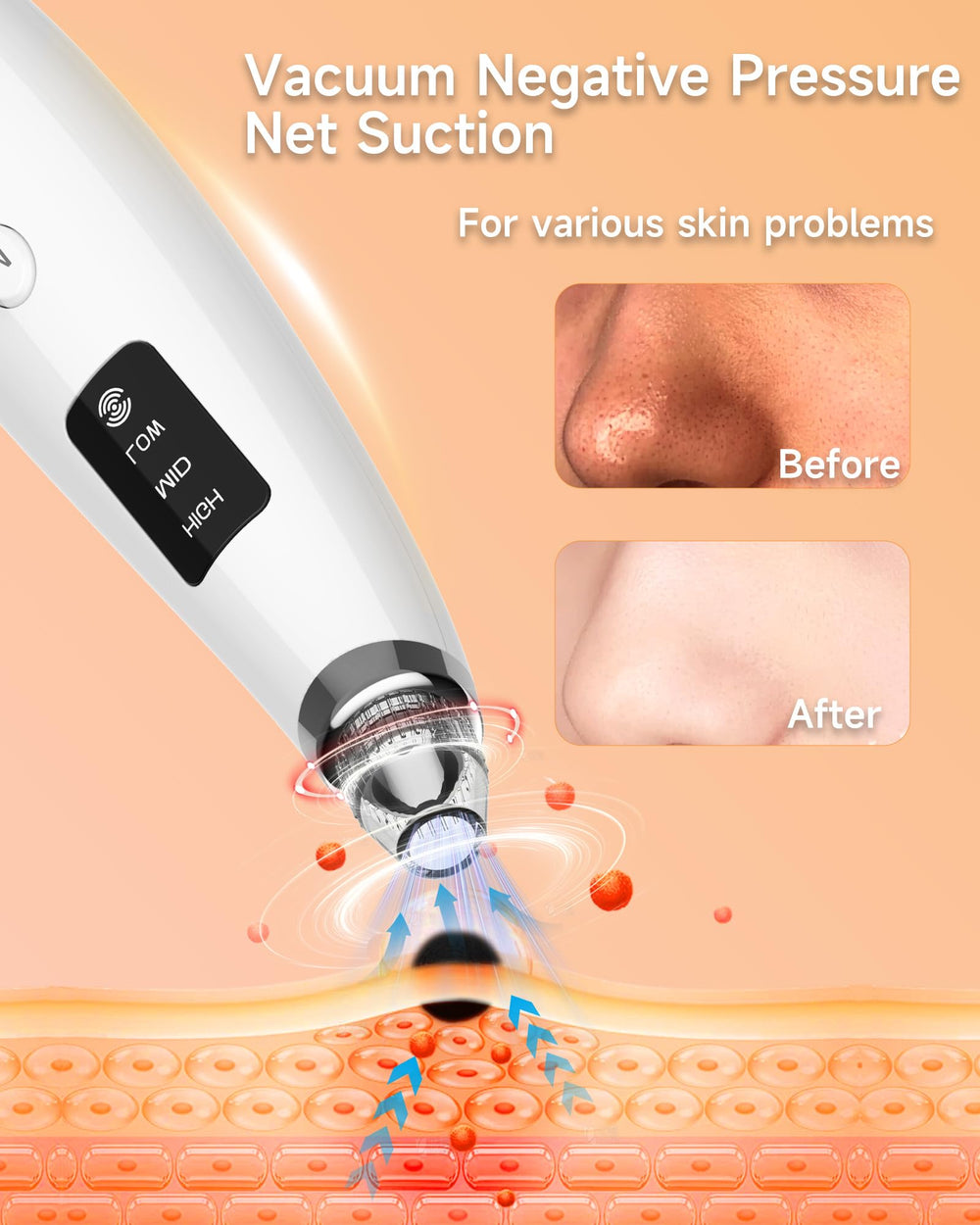 Miley extracteur – niveaux d’aspiration ajustables pour tous les types de peau.