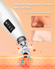 Miley extracteur – niveaux d’aspiration ajustables pour tous les types de peau.