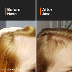 Minimalist Sérum Densité Cheveux 18% – Procapil et Anagain ciblent la chute potentielle