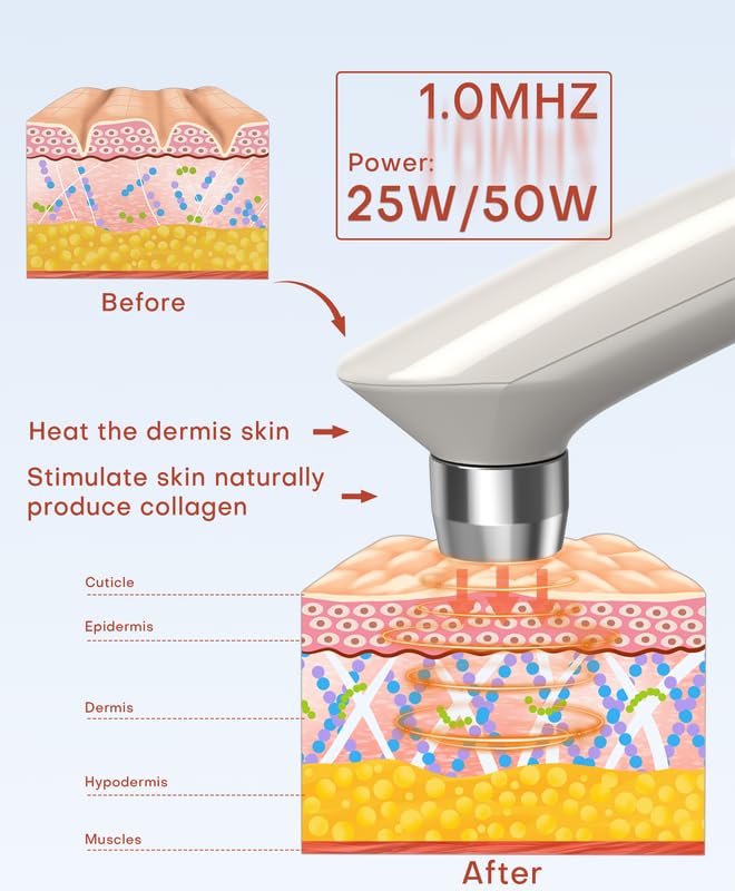 MLAY grande sonde RF visage pour raffermir les joues et la peau.