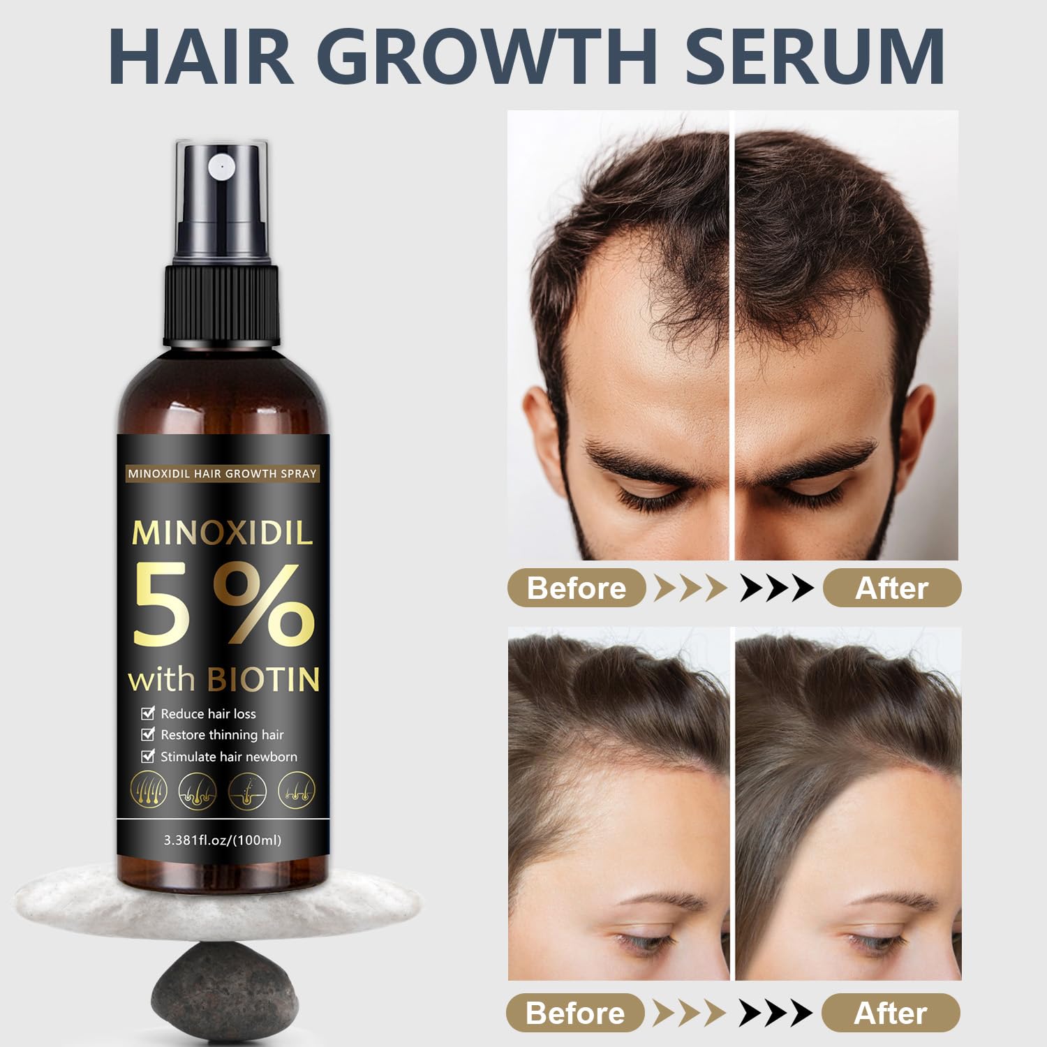 MOC LINK Minoxidil 5%, application ciblée sur le cuir chevelu.