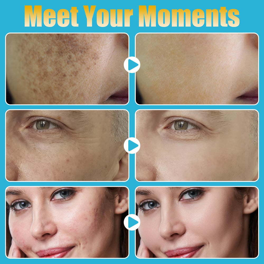 MONESAO Derma Roller portable et leger, idéal en voyage.