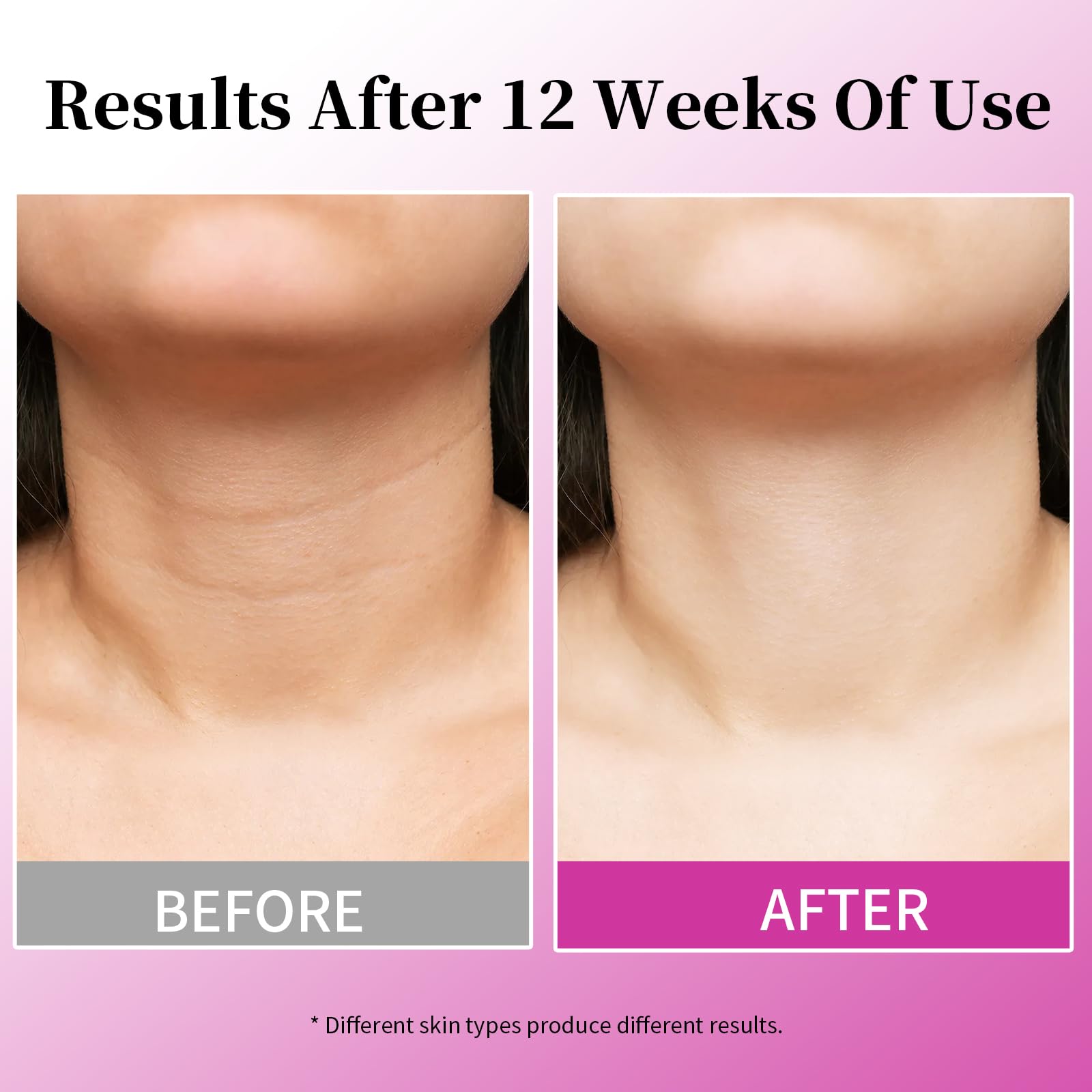 MRLILEI Beauty Crème Cou 4 en 1 – avant-apres, potentiel raffermissement du décolleté.