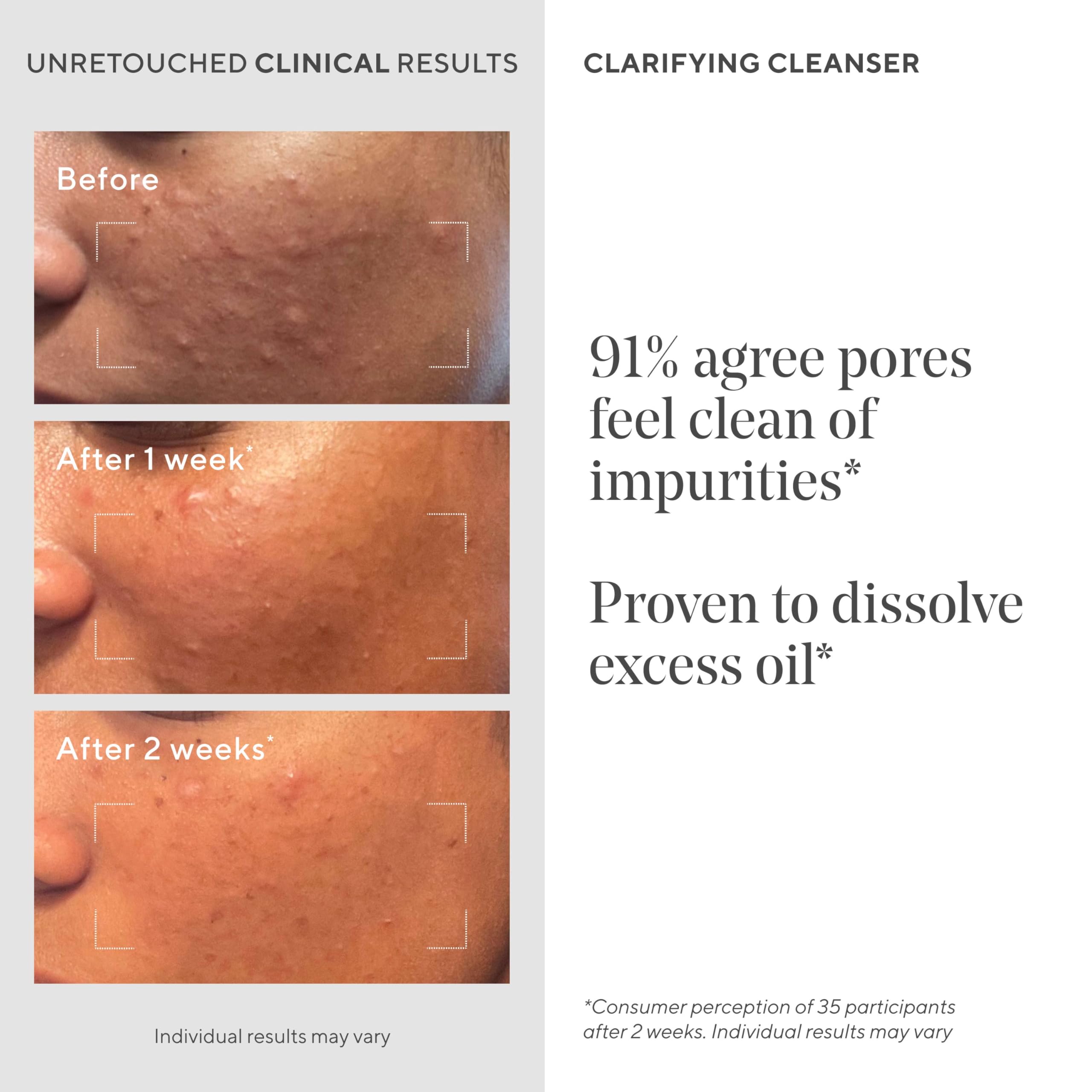 Murad Acne Control Clarifying Cleanser — purification des pores en profondeur