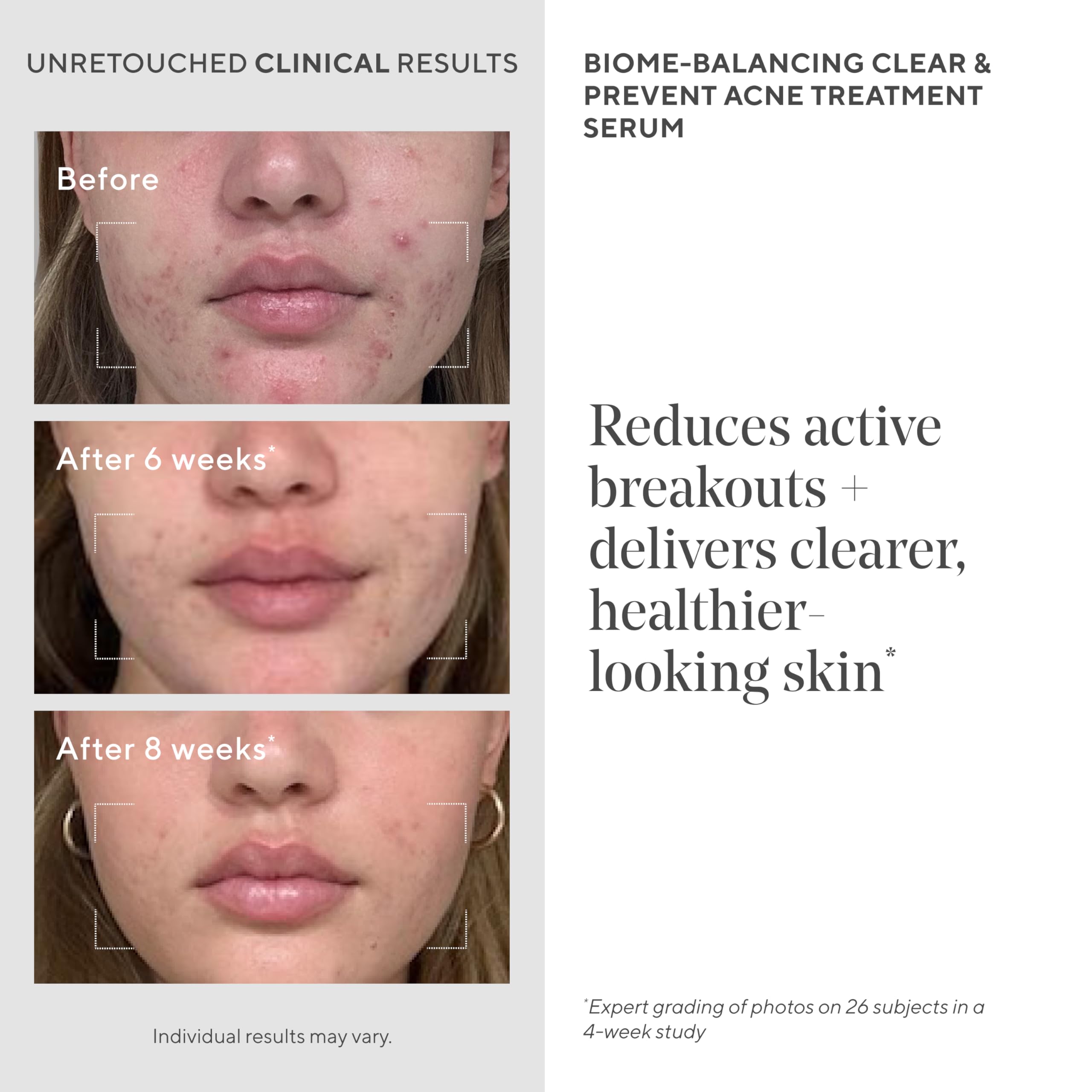 Murad nettoyant acné mousse, soin quotidien en douceur.