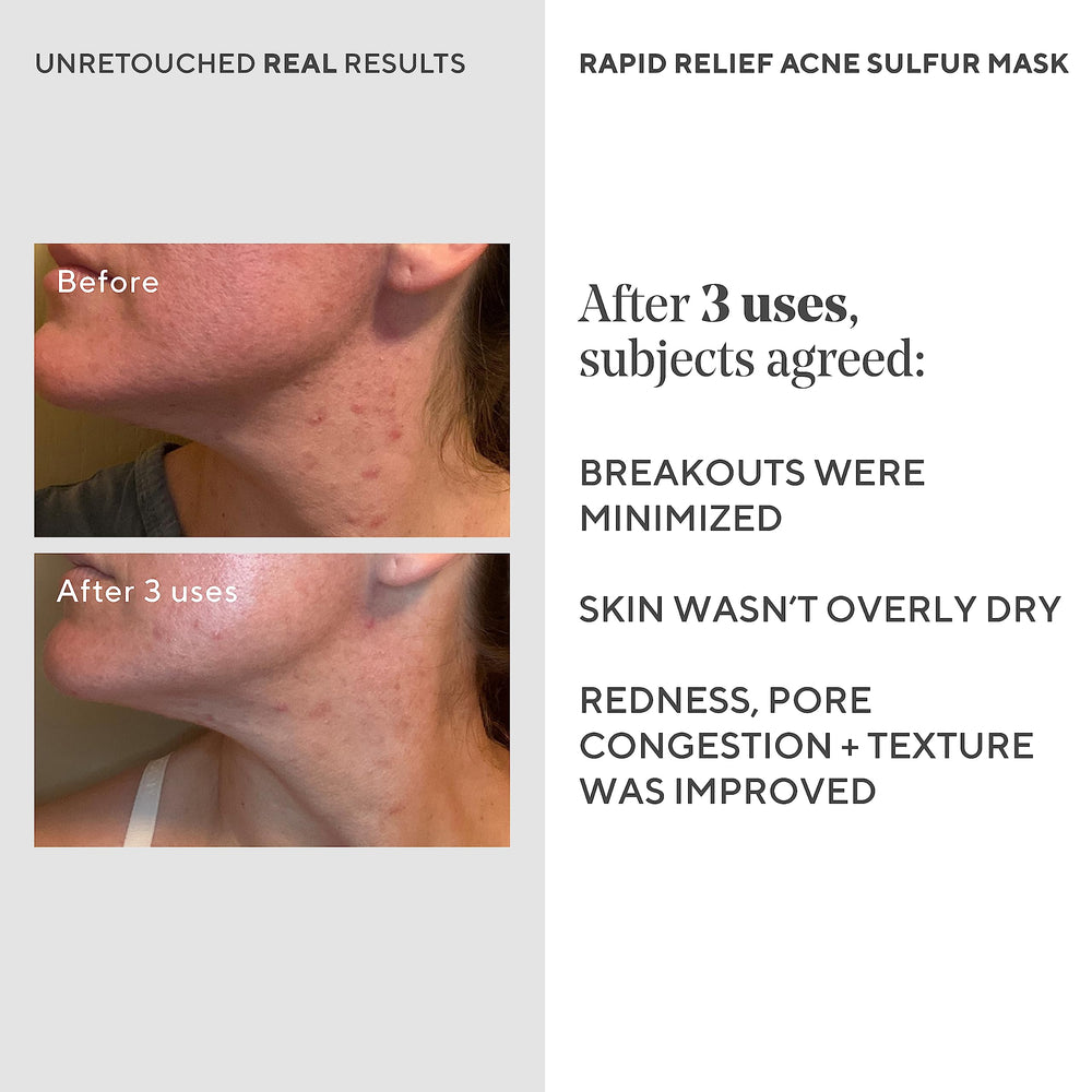 Murad Rapid Relief, argile kaolin purifiante pour les impuretés.