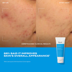 Murad soin point acné relief rapide 15 ml, application ciblée.
