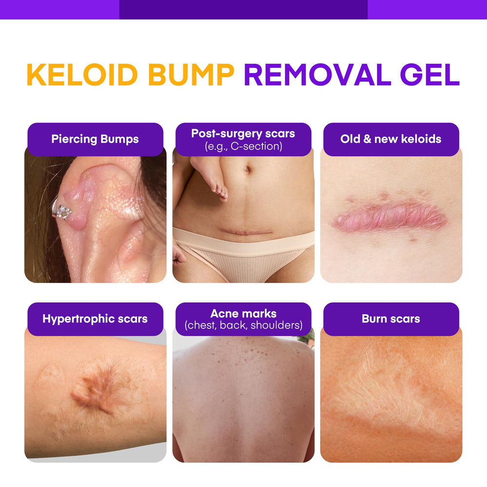 Application sur l’oreille avec le gel keloïde Bump de MURASAKI BEAUTY