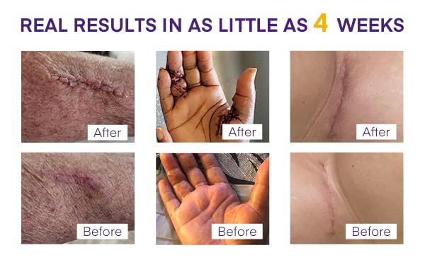 Massage doux recommandé pour optimiser les résultats du gel cicatrice MURASAKI BEAUTY