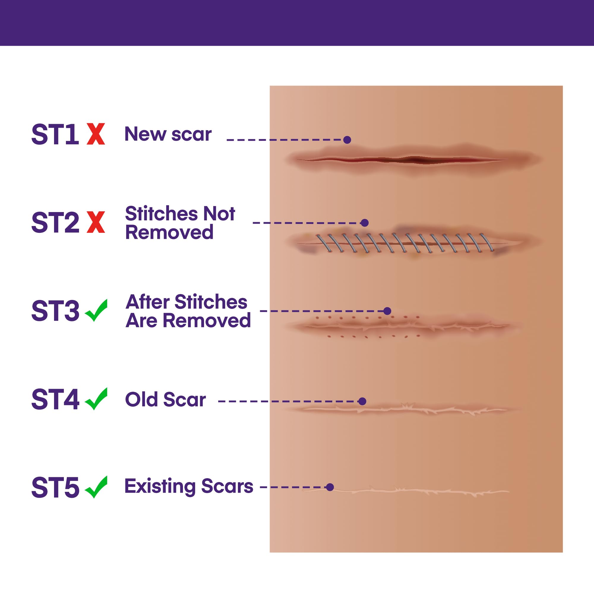 Solution non invasive pour amélioration des cicatrices selon MURASAKI BEAUTY