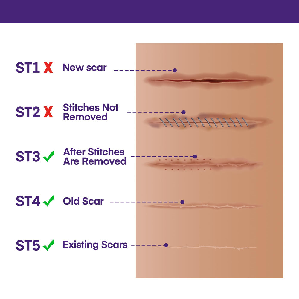 Solution non invasive pour amélioration des cicatrices selon MURASAKI BEAUTY