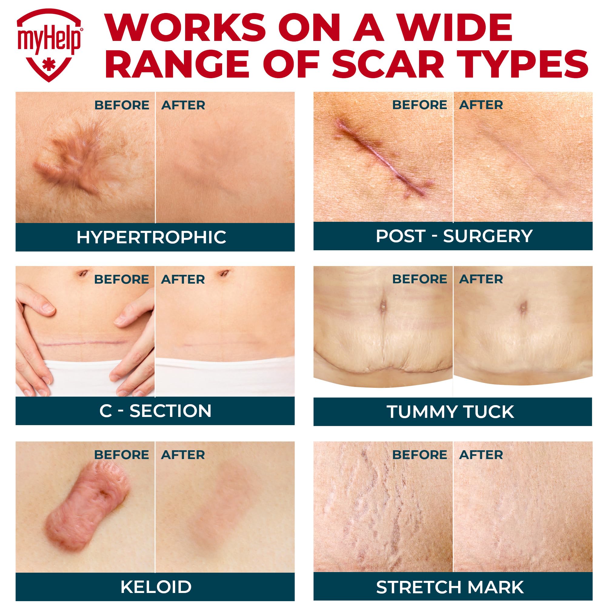 MYHELP tape silicone cicatrice-corps adhère durablement sur la peau.
