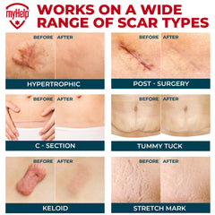 MYHELP tape silicone cicatrice-corps adhère durablement sur la peau.