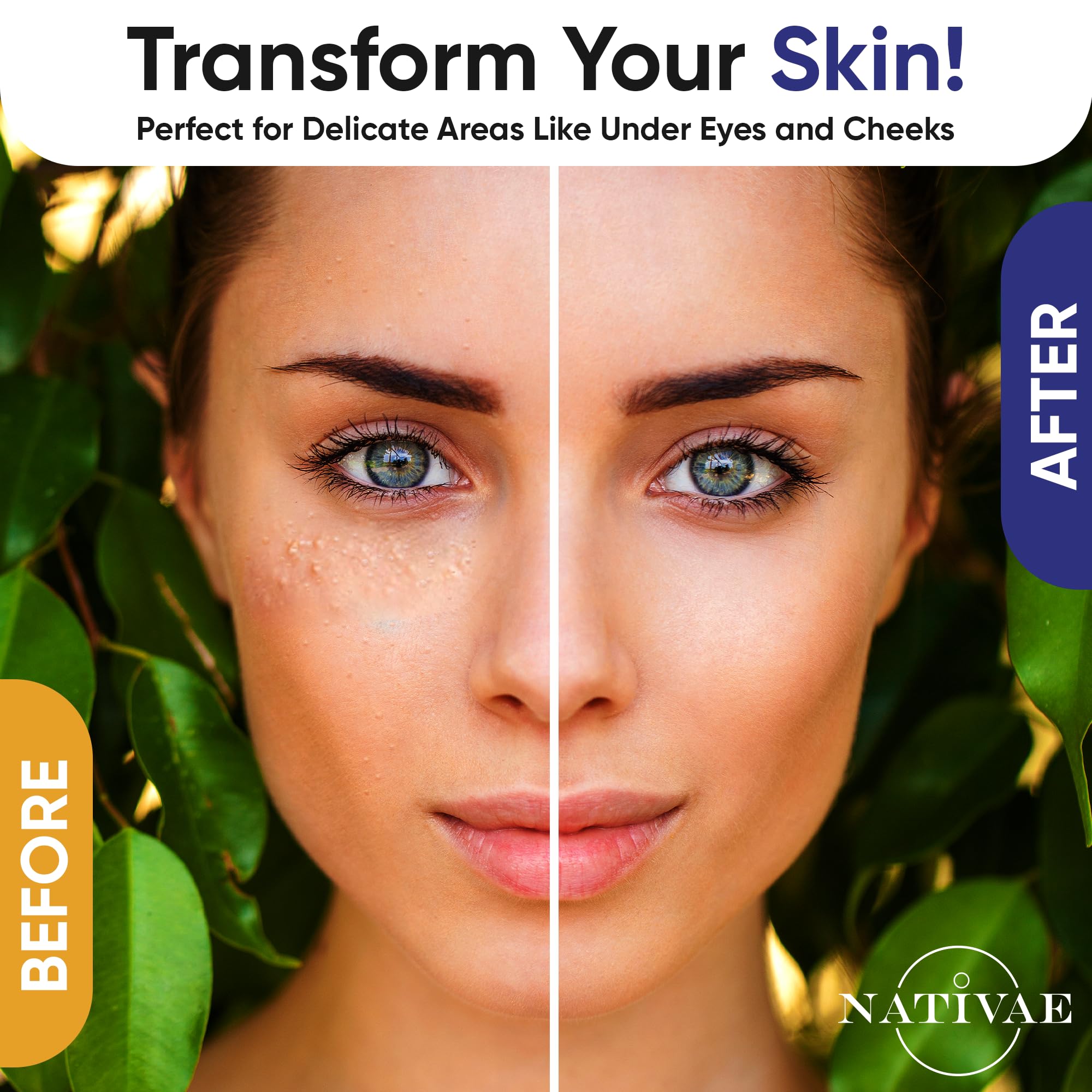 Nativae Milia Remover for forehead and cheeks promotes even skin tone.