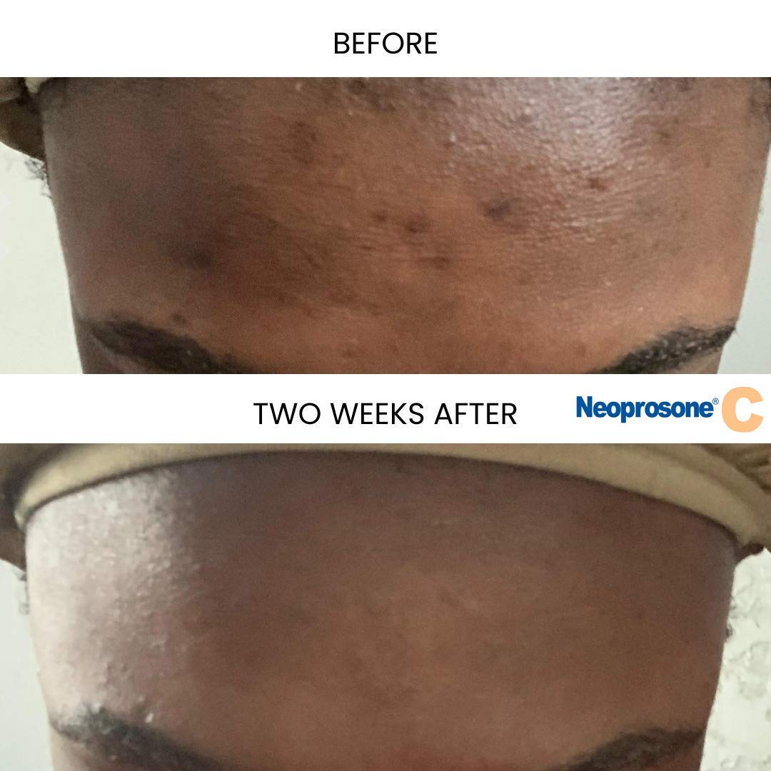 Neoprosone sérum vitamine C, alpha arbutin, améliore l'uniformité du teint.