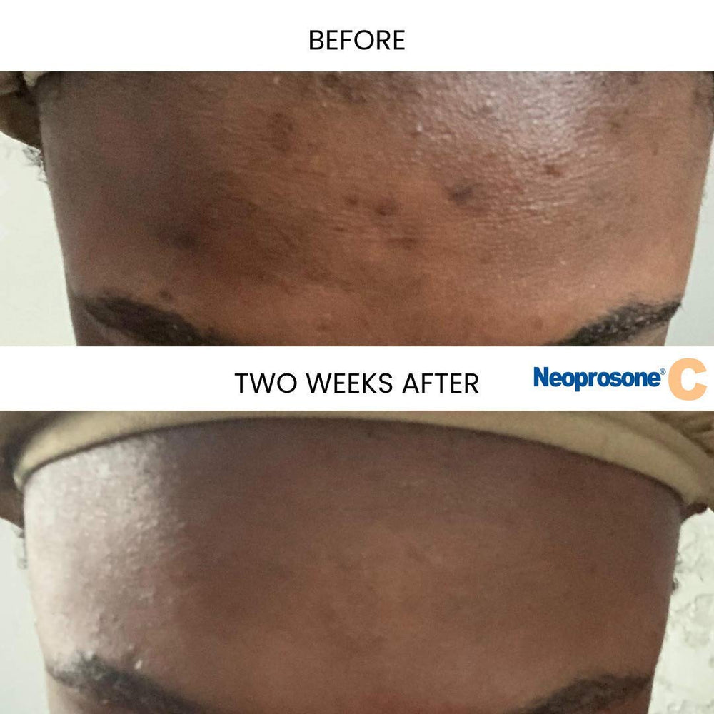 Neoprosone sérum vitamine C, alpha arbutin, améliore l'uniformité du teint.