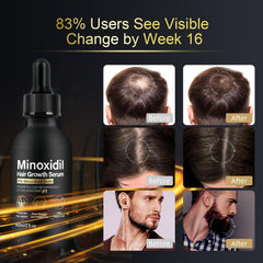 NETYIYUN Minoxidil 5% – Visuel indiquant résultats potentiels après utilisation régulière