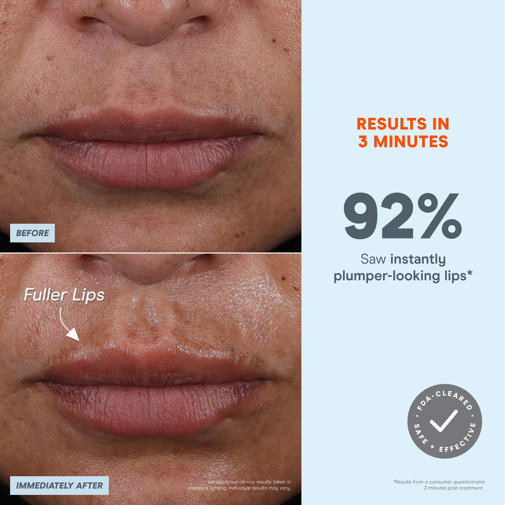 NuFACE FIX mode yeux – dégonflement et regard plus ouvert.