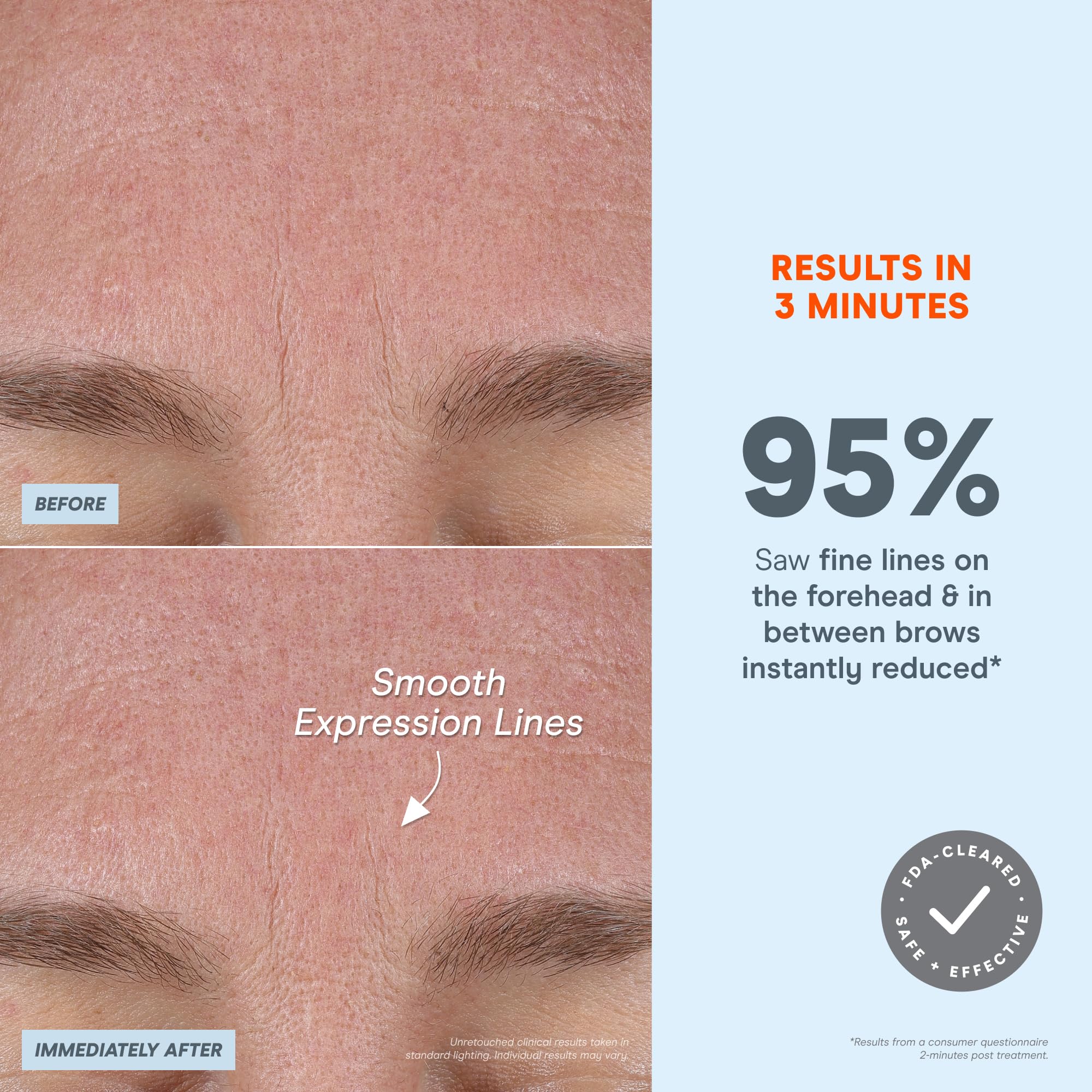 NuFACE FIX mode lignes – lignes fines lissées autour du sourire.