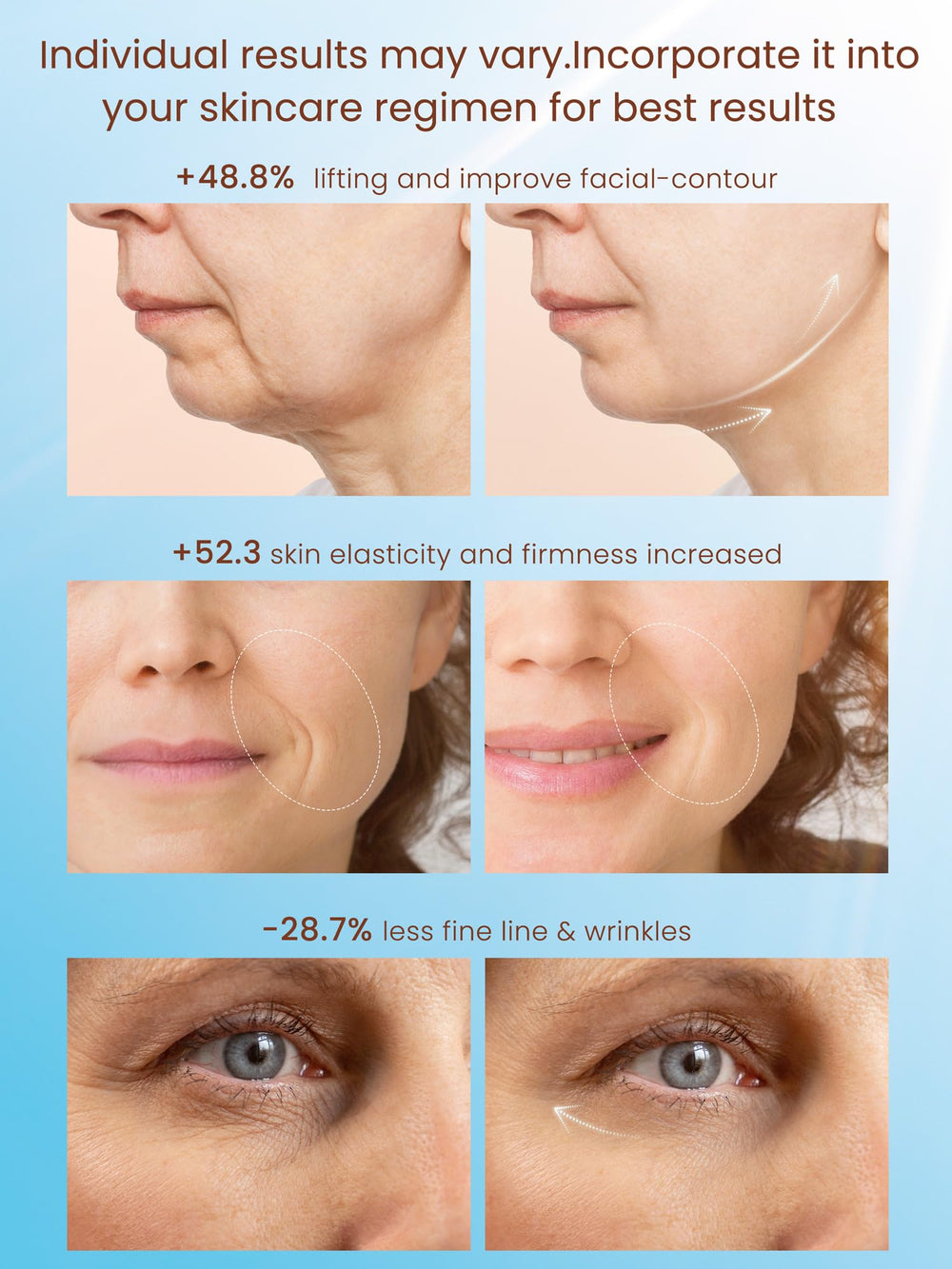 Nulift NL04 - mode-iap-stimulation-collagene favorise le tonus