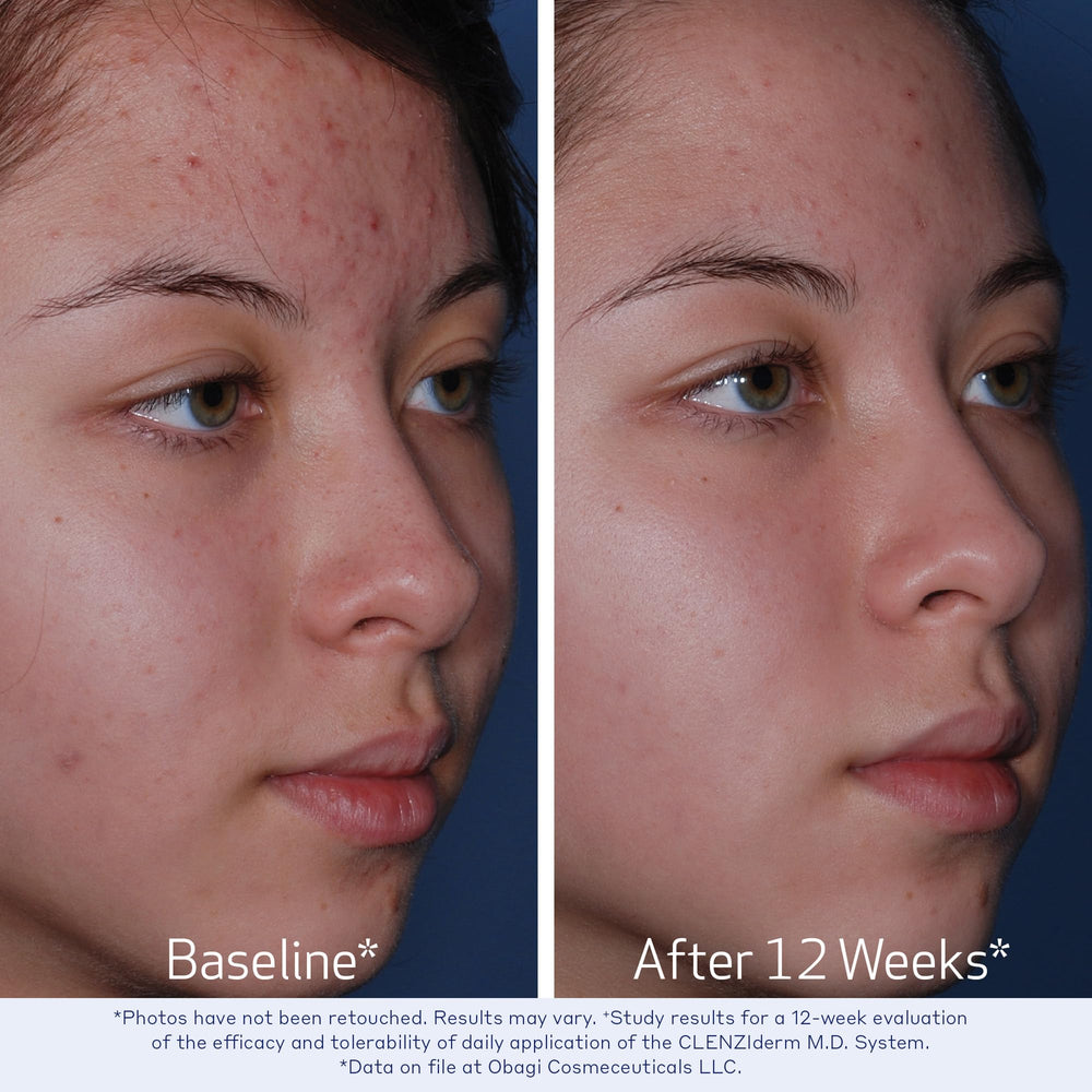 Obagi Clenziderm lotion traitement 5% BPO: ciblage des imperfections en douceur