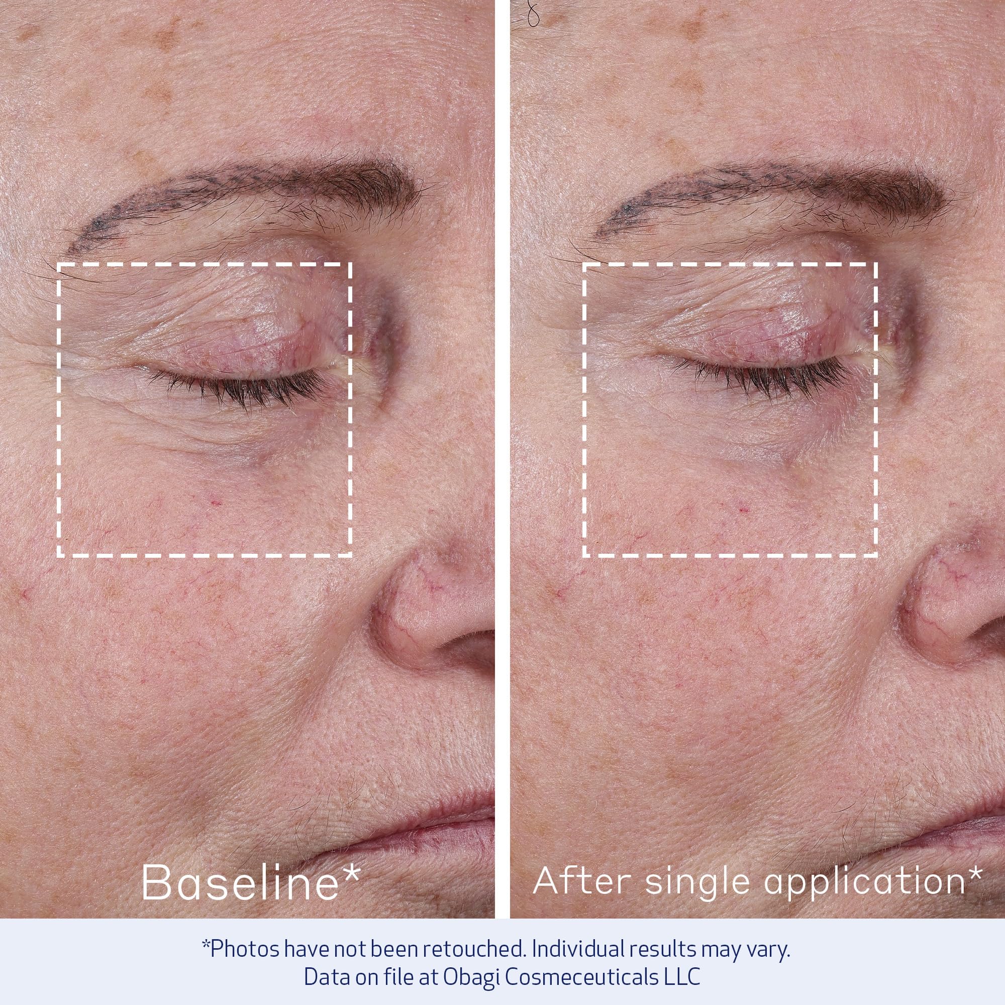 Obagi ELASTIderm Concentré Avancé – avant/après montrant une réduction visuelle des ridules.