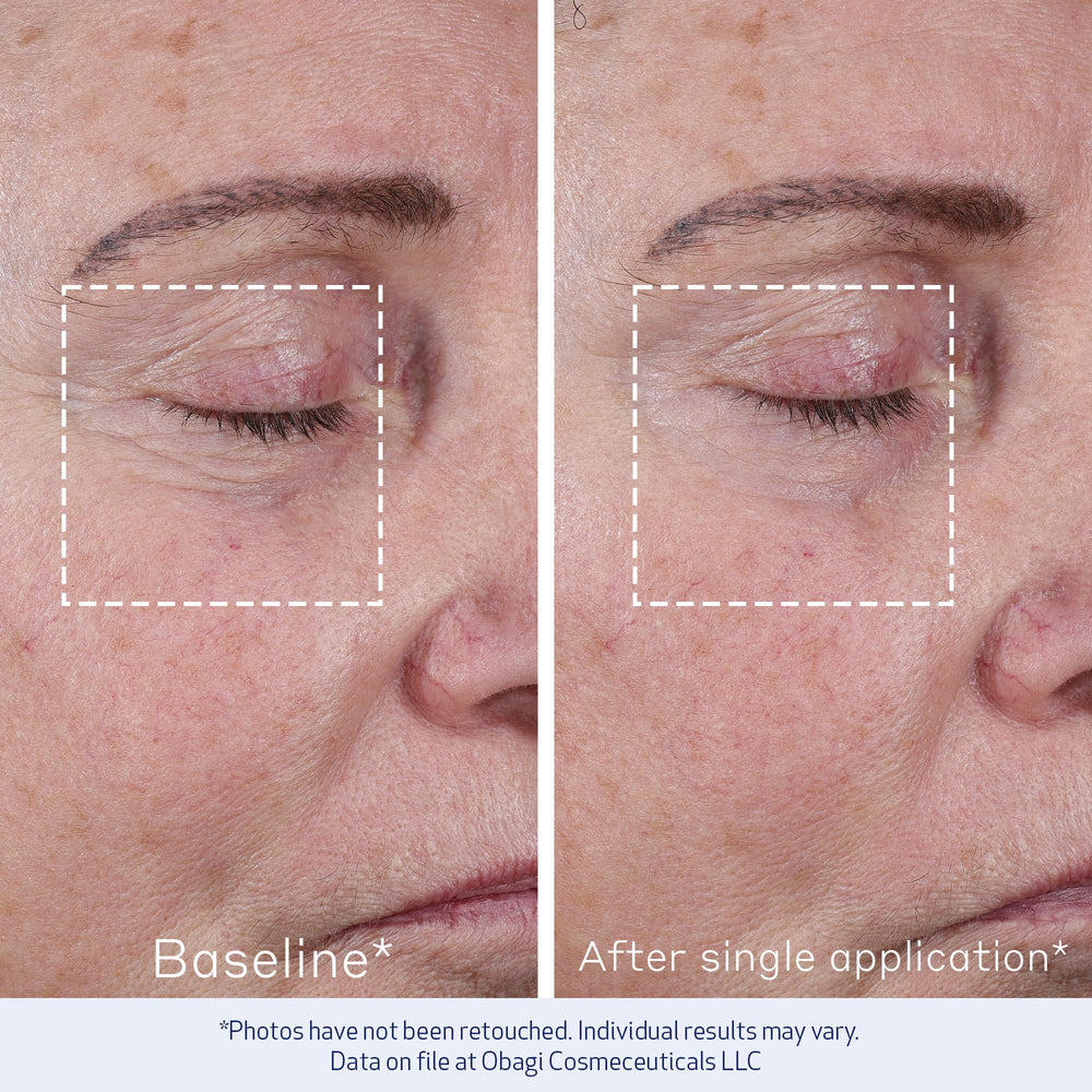 Obagi ELASTIderm Concentré Avancé – avant/après montrant une réduction visuelle des ridules.