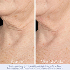 Obagi ELASTIderm Cou Décolleté Avant Après — démonstration d'améliorations potentielles.