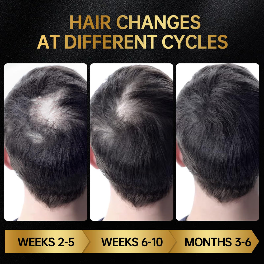 OCSINL Minoxidil appliqué sur cuir chevelu, routine quotidienne facilitée.