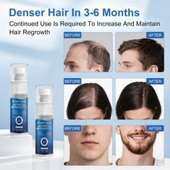 OCVWJKD Minoxidil, massage du cuir chevelu – absorption facilitée