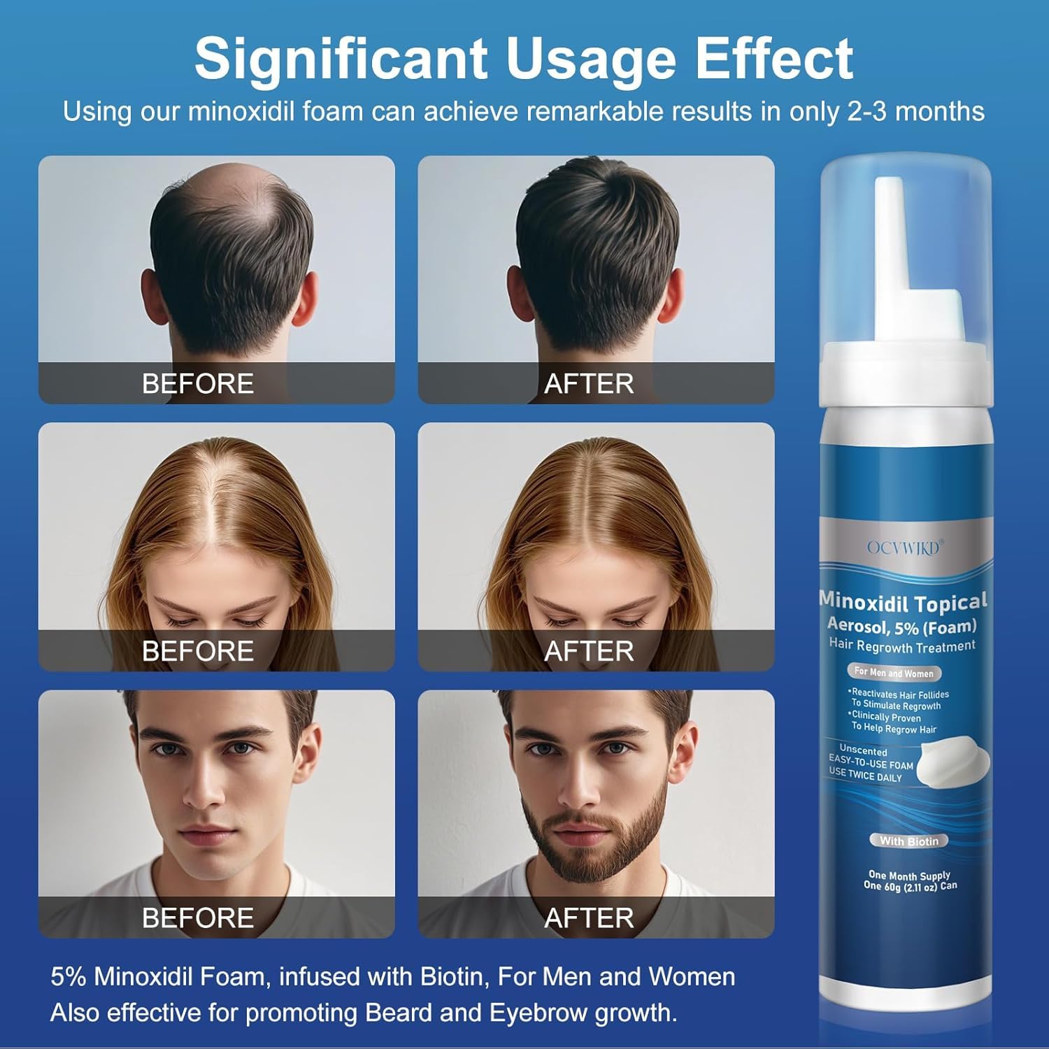 OCVWJKD Application facile de la mousse Minoxidil sur le cuir chevelu.
