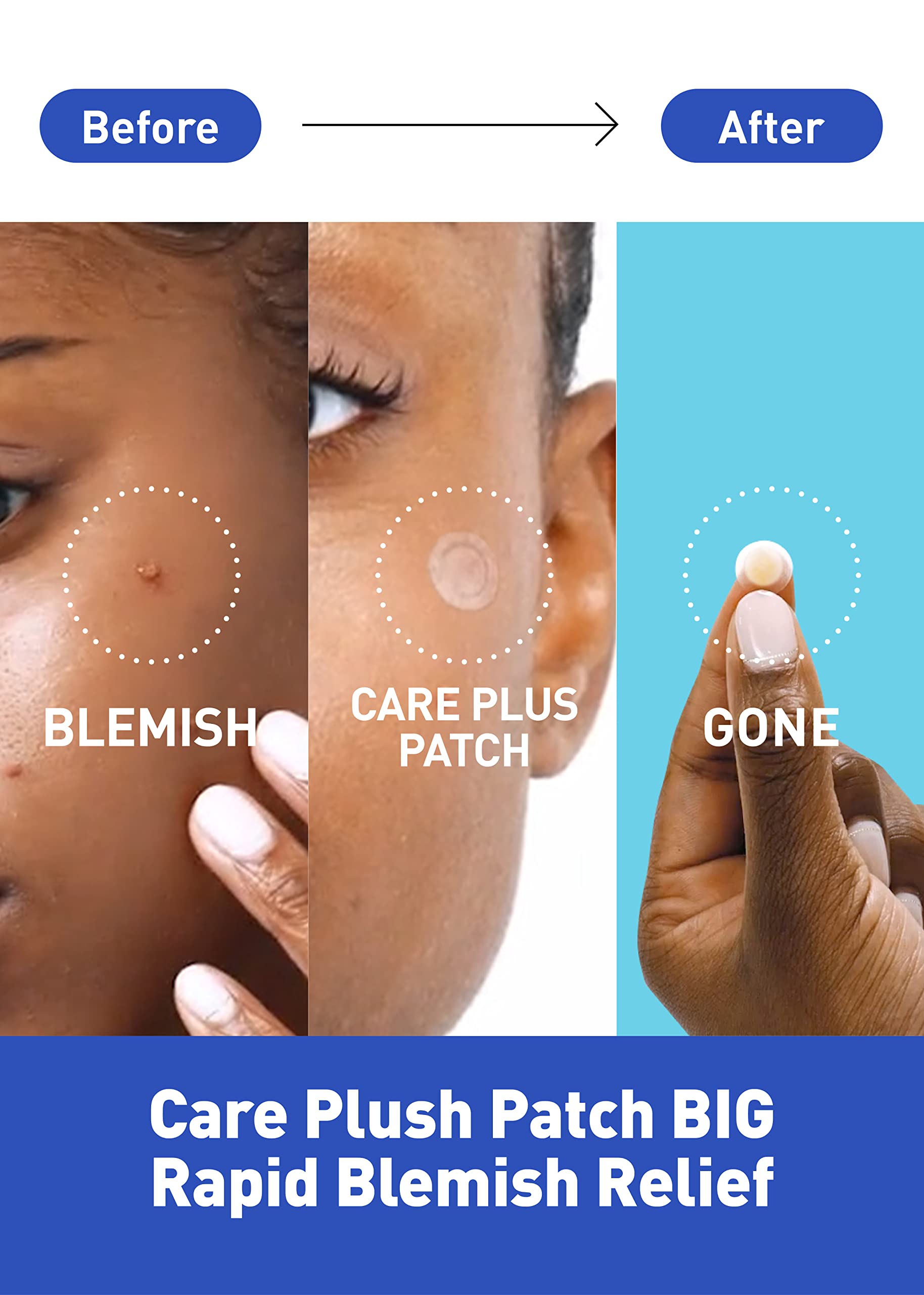 OLIVE YOUNG Care Plus Spot Patch, boîte pack3 prête à l'emploi pour soins ciblés.