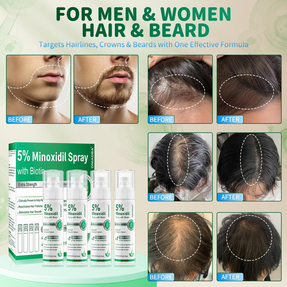 ONIADBA minoxidil spray being applied to the scalp for density support