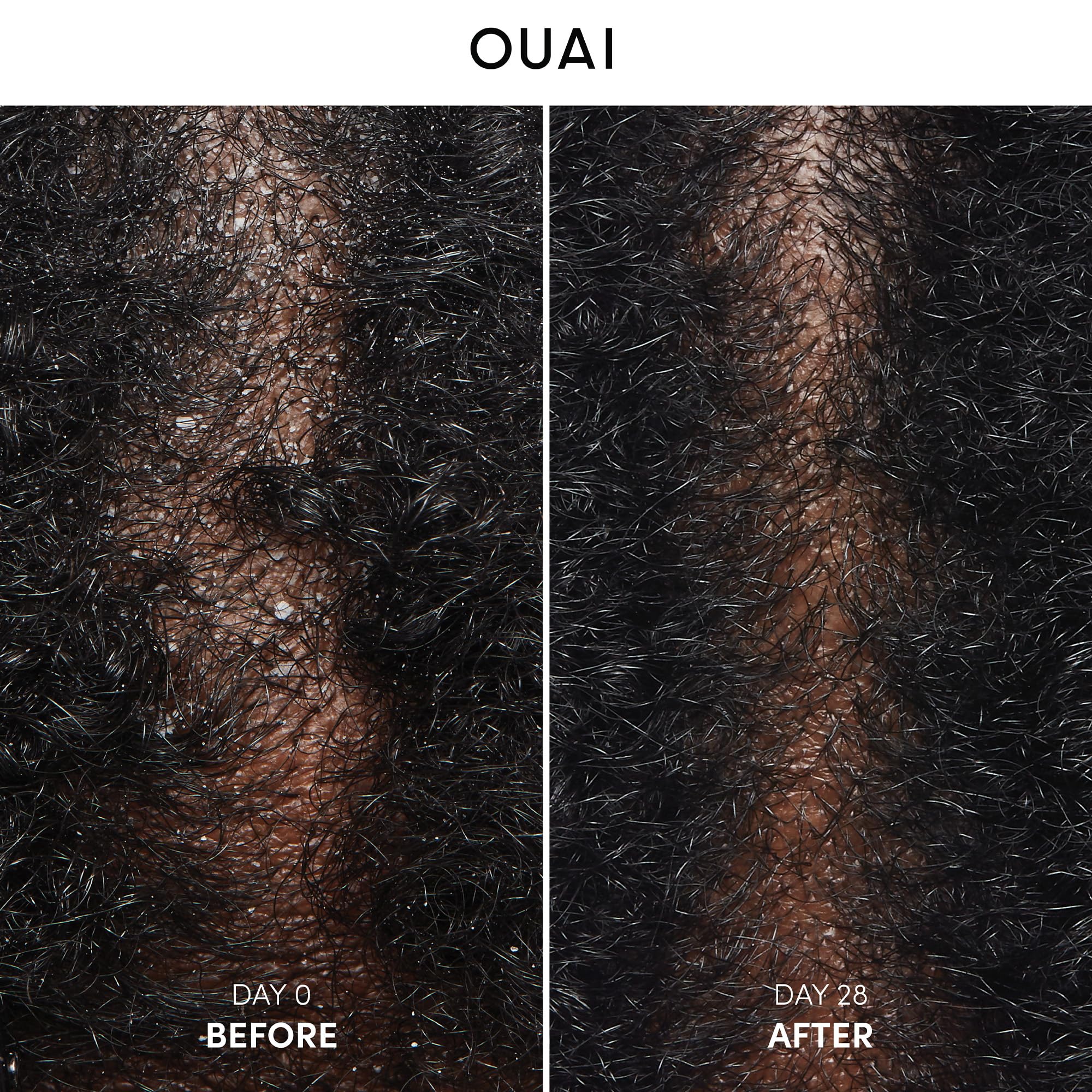 OUAI shampooing antipelliculaire, mousse douce pour démêler et nettoyer le cuir chevelu.