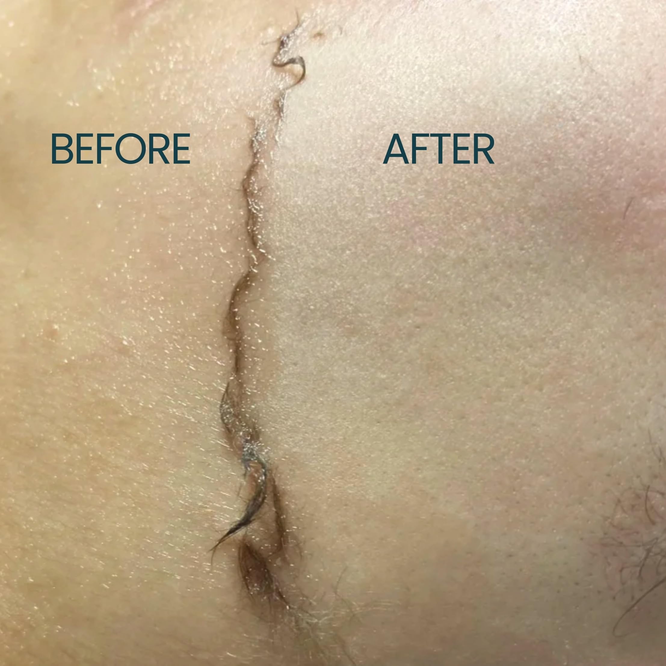 Protection légère contre irritations lors du rasage avec Dermaplane.